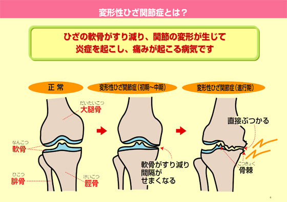 変形性ひざ関節症