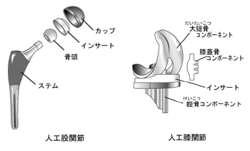 人工股関節・人工膝関節