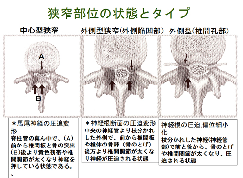 狭窄部位の状態とタイプ