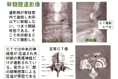 脊髄腔造影像