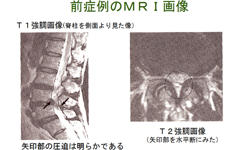 前症例のＭＲＩ画像