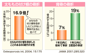 骨粗鬆症で1度骨折をおこすと、次々と骨折をおこす危険が大きくなります。