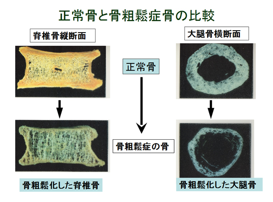 正常骨と骨粗鬆症骨の比較