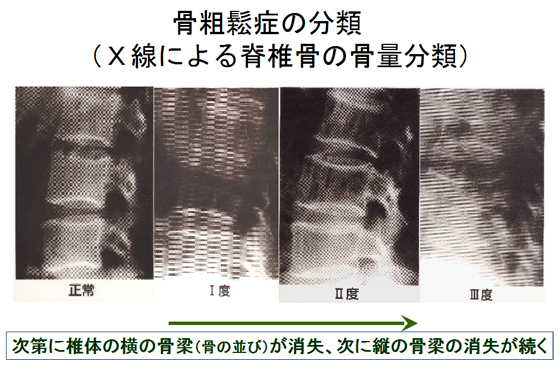 骨粗鬆症の分類