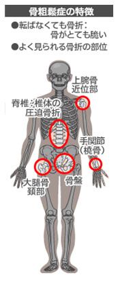 骨粗鬆症